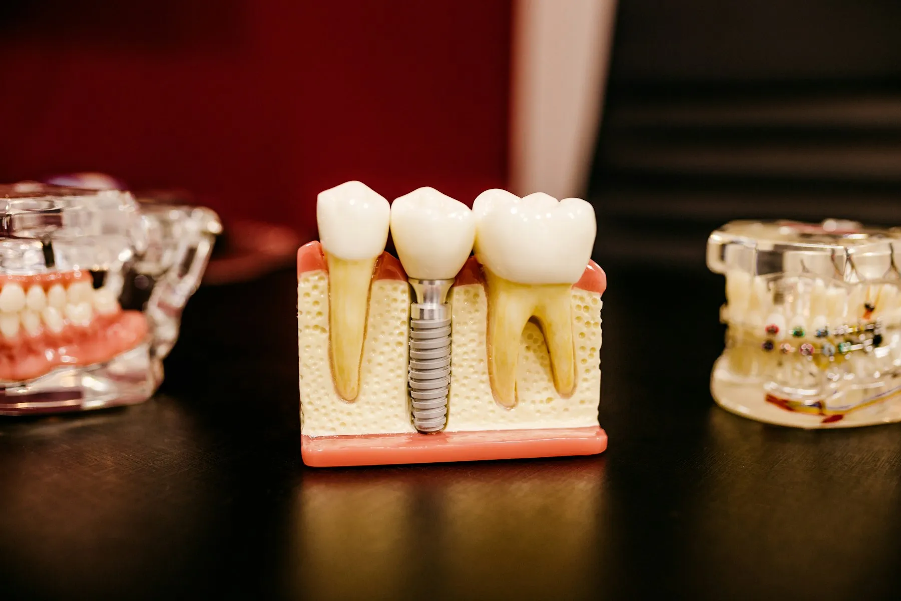Sectioned teaching model showing an implant seated in bone between two natural teeth